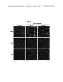 HYPOSIALYLATION DISORDERS diagram and image