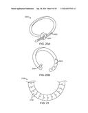 INTRA-VAGINAL DEVICES AND METHODS FOR TREATING FECAL INCONTINENCE diagram and image