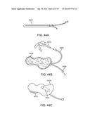 INTRA-VAGINAL DEVICES AND METHODS FOR TREATING FECAL INCONTINENCE diagram and image