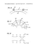 Devices, Systems and Methods for Treating Benign Prostatic Hyperplasia and     Other Conditions diagram and image