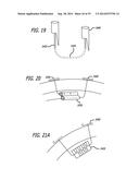 Devices, Systems and Methods for Treating Benign Prostatic Hyperplasia and     Other Conditions diagram and image