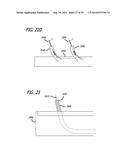 Devices, Systems and Methods for Treating Benign Prostatic Hyperplasia and     Other Conditions diagram and image