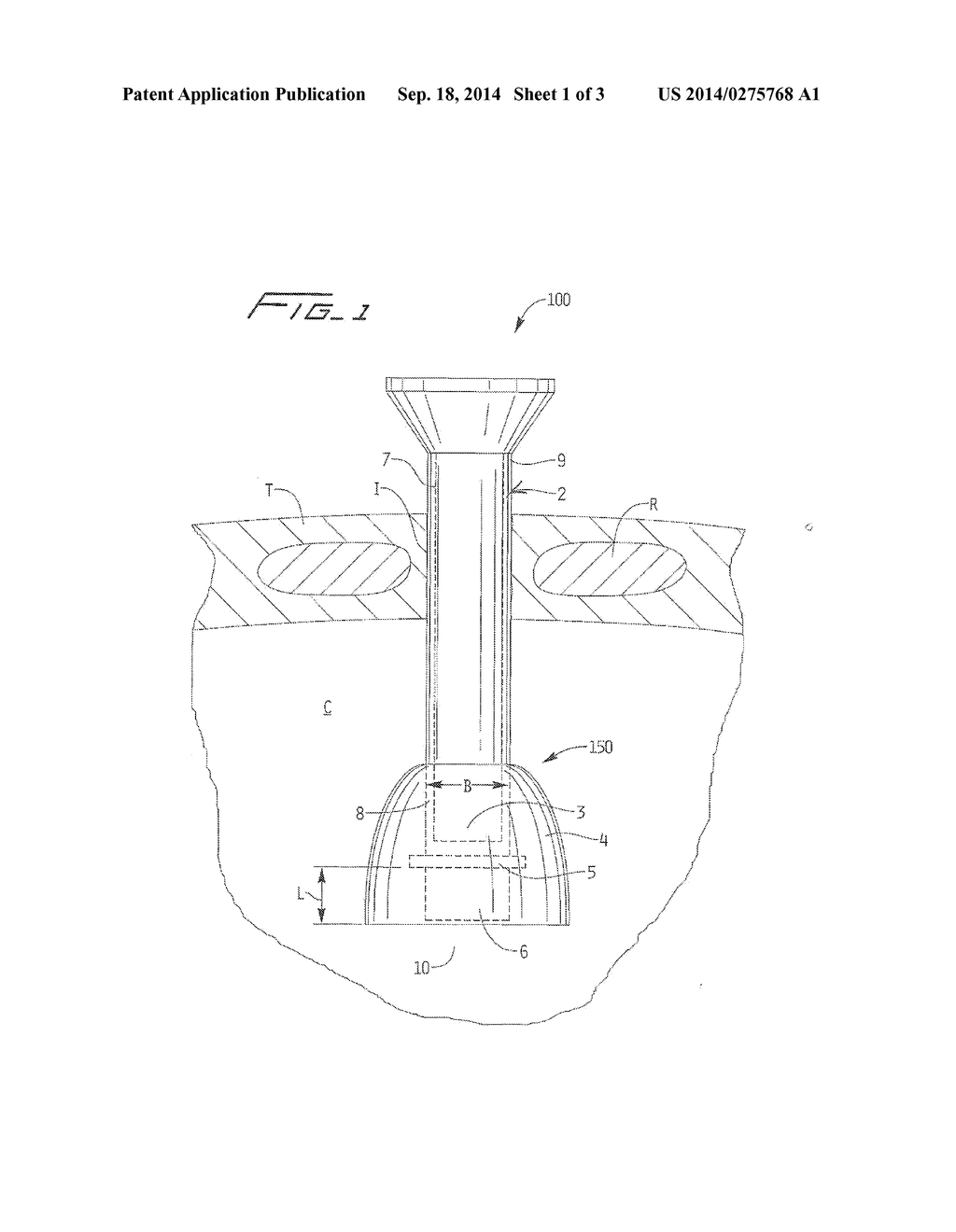 Thoracic Scope With Skirt And Gap - diagram, schematic, and image 02