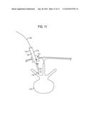 SURGICAL RETRACTORS diagram and image