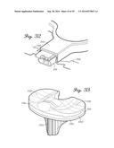 Muscular-Skeletal Joint Stability Detection and Method Therefor diagram and image