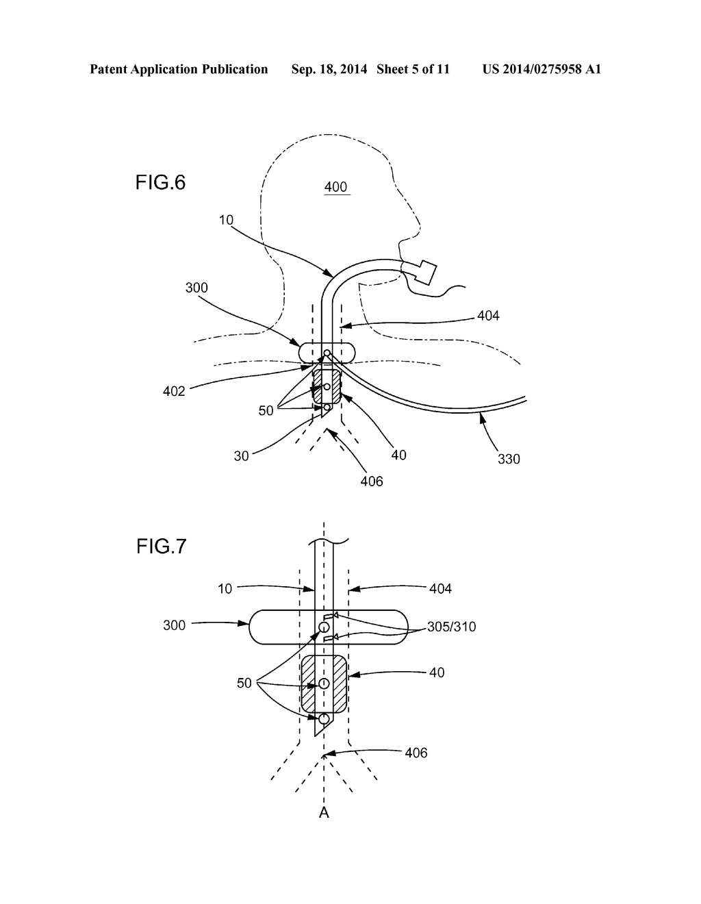 METHODS AND SYSTEMS FOR VERIFYING AND MONITORING ENDOTRACHEAL TUBE     POSITION DURING INTUBATION - diagram, schematic, and image 06