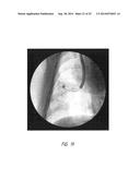 Device for Minimally Invasive Delivery of Treatment Substance diagram and image