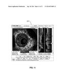 COREGISTERED INTRAVASCULAR AND ANGIOGRAPHIC IMAGES diagram and image