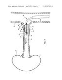 QUANTIFICATION OF RENAL DENERVATION VIA ALTERATIONS IN RENAL BLOOD FLOW     PRE/POST ABLATION diagram and image