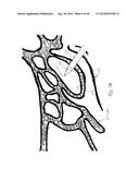 APPARATUS AND METHOD FOR TREATMENT OF ETHMOID SINUSITIS diagram and image