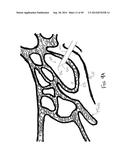 APPARATUS AND METHOD FOR TREATMENT OF ETHMOID SINUSITIS diagram and image