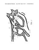 APPARATUS AND METHOD FOR TREATMENT OF ETHMOID SINUSITIS diagram and image