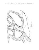 APPARATUS AND METHOD FOR TREATMENT OF ETHMOID SINUSITIS diagram and image