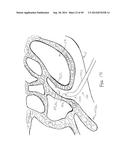 APPARATUS AND METHOD FOR TREATMENT OF ETHMOID SINUSITIS diagram and image