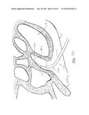 APPARATUS AND METHOD FOR TREATMENT OF ETHMOID SINUSITIS diagram and image