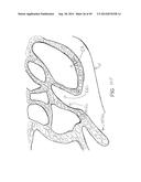 APPARATUS AND METHOD FOR TREATMENT OF ETHMOID SINUSITIS diagram and image