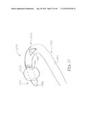 APPARATUS AND METHOD FOR TREATMENT OF ETHMOID SINUSITIS diagram and image