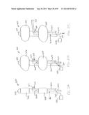 APPARATUS AND METHOD FOR TREATMENT OF ETHMOID SINUSITIS diagram and image