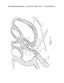 APPARATUS AND METHOD FOR TREATMENT OF ETHMOID SINUSITIS diagram and image