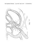 APPARATUS AND METHOD FOR TREATMENT OF ETHMOID SINUSITIS diagram and image