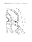 APPARATUS AND METHOD FOR TREATMENT OF ETHMOID SINUSITIS diagram and image