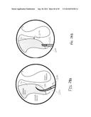 APPARATUS AND METHOD FOR TREATMENT OF ETHMOID SINUSITIS diagram and image