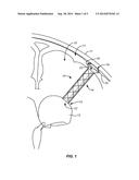 DEVICES, SYSTEMS AND METHODS FOR DIVERTING FLUID TRAPPED IN A SOLID ORGAN diagram and image