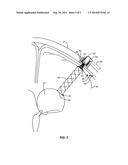 DEVICES, SYSTEMS AND METHODS FOR DIVERTING FLUID TRAPPED IN A SOLID ORGAN diagram and image