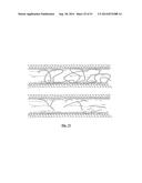 EMBOLIZATION SYSTEMS diagram and image