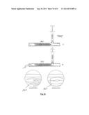 EMBOLIZATION SYSTEMS diagram and image