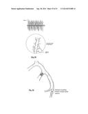 EMBOLIZATION SYSTEMS diagram and image