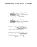 EMBOLIZATION SYSTEMS diagram and image