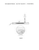 EMBOLIZATION SYSTEMS diagram and image