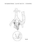 EMBOLIZATION SYSTEMS diagram and image