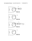 METHOD OF TREATING INFECTIONS, DISEASES OR DISORDERS OF NAIL UNIT diagram and image