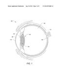 VARYING A NUMERICAL APERTURE OF A LASER DURING LENS FRAGMENTATION IN     CATARACT SURGERY diagram and image