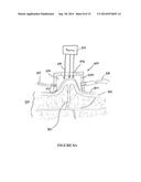 TREATMENT OF TISSUE diagram and image