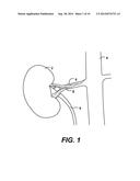 MEDIGUIDE-ENABLED RENAL DENERVATION SYSTEM FOR ENSURING WALL CONTACT AND     MAPPING LESION LOCATIONS diagram and image