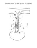 FEEDBACK SYSTEMS AND METHODS UTILIZING TWO OR MORE SITES ALONG DENERVATION     CATHETER diagram and image