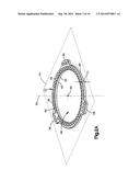 External Bone Fixation Device diagram and image