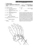 EXTERNAL FIXATION diagram and image