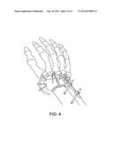 EXTERNAL FIXATION diagram and image