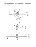 EXTERNAL FIXATION diagram and image