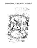 External Bone Fixation Device diagram and image