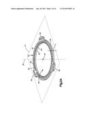 External Bone Fixation Device diagram and image