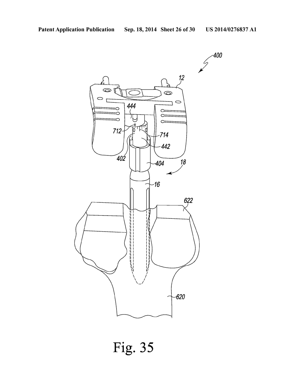 FEMORAL ORTHOPAEDIC INSTRUMENT ASSEMBLY FOR SETTING OFFSET - diagram, schematic, and image 27