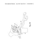 FEMORAL ORTHOPAEDIC INSTRUMENT ASSEMBLY FOR SETTING OFFSET diagram and image