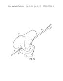 METHODS, SYSTEMS, AND DEVICES FOR GAUGING A BONE TUNNEL diagram and image