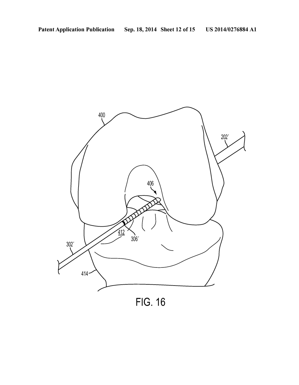 METHODS, SYSTEMS, AND DEVICES FOR GAUGING A BONE TUNNEL - diagram, schematic, and image 13