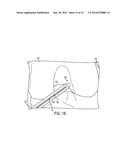 METHODS, SYSTEMS, AND DEVICES FOR GAUGING A BONE TUNNEL diagram and image